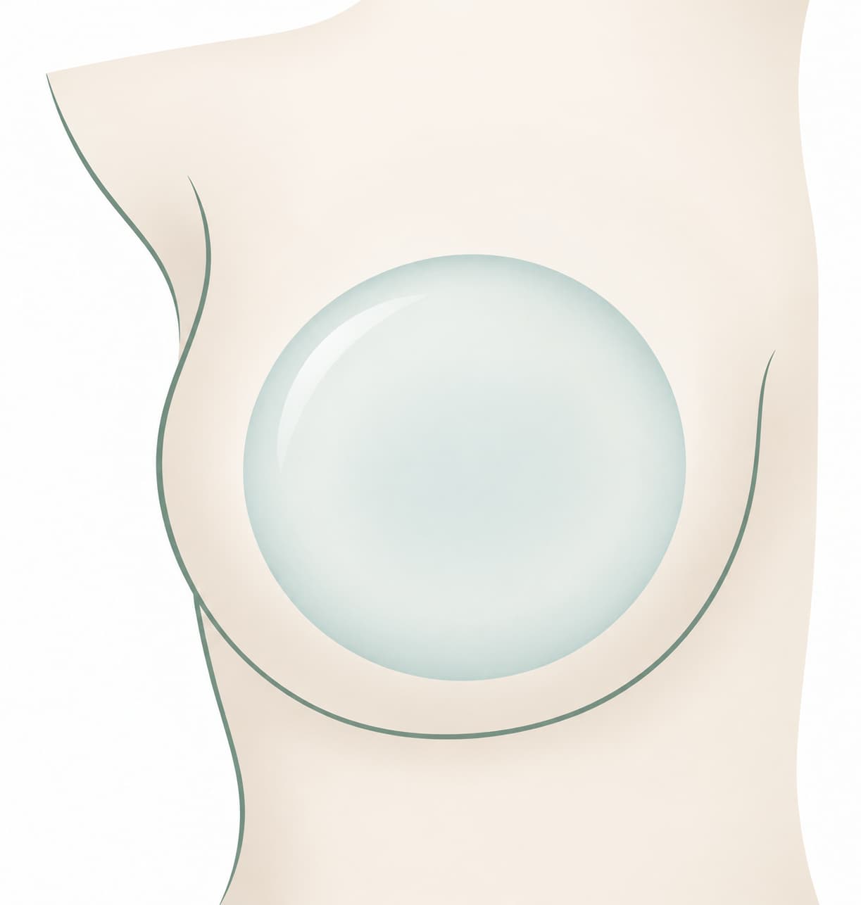 Vue de face simplifiée : contour du sein et implant rond, pour comparer leurs largeurs et la couverture autour de l’implant.